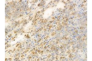 ABIN6264241 and ABIN6269167 at 1/100 staining human melanoma by IHC-P. (PKC alpha antibody  (C-Term))