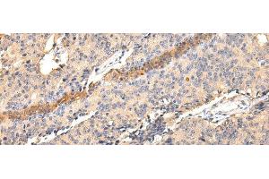 Immunohistochemistry of paraffin-embedded Human prostate cancer using SDCBP Polyclonal Antibody at dilution of 1/40 (SDCBP antibody)