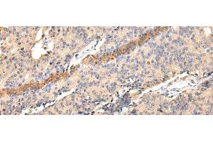 Immunohistochemistry of paraffin-embedded Human prostate cancer using SDCBP Polyclonal Antibody at dilution of 1/40 (SDCBP antibody)