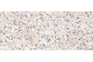 Immunohistochemistry of paraffin-embedded Human liver cancer tissue using TNNT1 Polyclonal Antibody at dilution of 1:35(x200) (TNNT1 antibody)