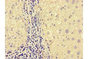 Immunohistochemistry of paraffin-embedded human liver cancer using ABIN7160331 at dilution of 1:100 (FAT Atypical Cadherin 2 (FAT2) (AA 123-314) antibody)