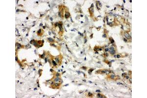 Anti-COMT antibody, IHC(P) IHC(P): Human Lung Cancer Tissue (COMT antibody  (N-Term))