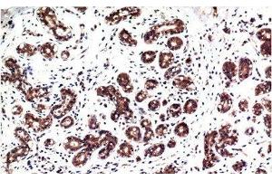 Immunohistochemistry of paraffin-embedded Human breast carcinoma tissue with Phospho-ERK 1/2 (Tyr222/205) Monoclonal Antibody at dilution of 1:200 (ERK1/2 antibody  (pTyr205, pTyr222))
