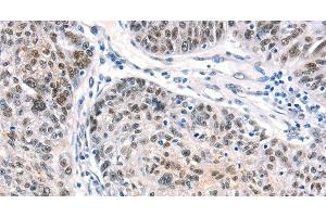 Immunohistochemistry of paraffin-embedded Human ovarian cancer using CTBP2 Polyclonal Antibody at dilution of 1:40 (CTBP2 antibody)