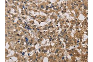 The image on the left is immunohistochemistry of paraffin-embedded Human thyroid cancer tissue using ABIN7129190(DEGS1 Antibody) at dilution 1/40, on the right is treated with fusion protein. (DEGS1 antibody)