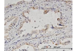 Immunoperoxidase of purified MaxPab antibody to IMPA2 on formalin-fixed paraffin-embedded human colon cancer.