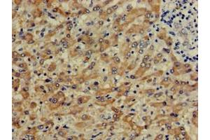 Immunohistochemistry of paraffin-embedded human liver cancer using ABIN7148969 at dilution of 1:100 (CTH antibody  (AA 1-70))