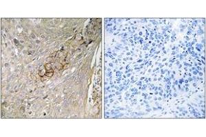 Immunohistochemistry analysis of paraffin-embedded human lung carcinoma tissue, using SLC6A6 Antibody. (TAUT antibody  (AA 561-610))