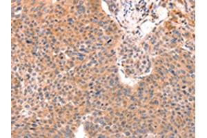 The image on the left is immunohistochemistry of paraffin-embedded Human liver cancer tissue using ABIN7129152(DAZ4 Antibody) at dilution 1/50, on the right is treated with fusion protein. (DAZ4 antibody)