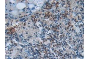 Detection of CC16 in Human Lung cancer Tissue using Polyclonal Antibody to Clara Cell Protein 16 (CC16) (SCGB1A1 antibody  (AA 23-91))