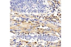 Immunohistochemistry analysis of paraffin-embedded human colon cancer using MFAP4 (ABIN7074614) at dilution of 1: 2000 (MFAP4 antibody)