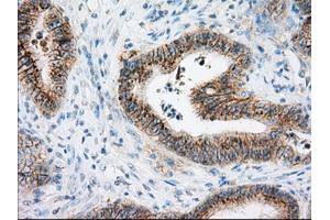 Immunohistochemical staining of paraffin-embedded Adenocarcinoma of colon tissue using anti-BSG mouse monoclonal antibody. (CD147 antibody)