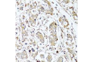 Immunohistochemistry of paraffin-embedded human gastric cancer using CPA1 antibody. (CPA1 antibody)
