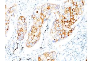 Formalin-fixed, paraffin-embedded human Lung SCC stained with Cytokeratin 7/17 Mouse Monoclonal Antibody (C-46). (Keratin 7/17 antibody)