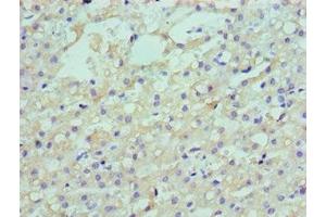 Immunohistochemistry of paraffin-embedded human liver cancer using ABIN7158555 at dilution of 1:100 (LDLRAP1 antibody  (AA 59-308))