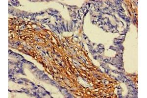 Immunohistochemistry of paraffin-embedded human colon cancer using ABIN7144568 at dilution of 1:100 (ARAP3 antibody  (AA 163-320))