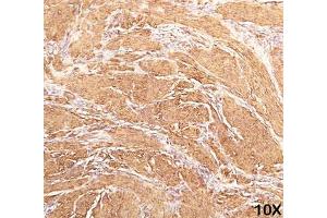 IHC staining of human leiomyosarcoma (10X) with Muscle actin antibody (HHF35). (Actin antibody)