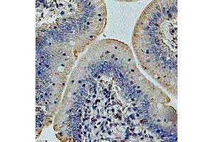 Immunohistochemical analysis of GP73 staining in human colon cancer formalin fixed paraffin embedded tissue section. (GOLM1 antibody)