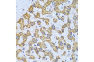 Immunohistochemistry of paraffin-embedded human liver cancer using PRKCD antibody at dilution of 1:100 (40x lens). (PKC delta antibody)