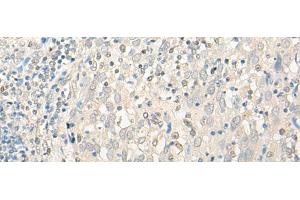Immunohistochemistry of paraffin-embedded Human cervical cancer tissue using UBXN1 Polyclonal Antibody at dilution of 1:35(x200) (UBXN1 antibody)