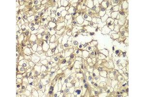 Immunohistochemistry of paraffin-embedded Human kidney cancer using CD1D Polyclonal Antibody at dilution of 1:200 (40x lens). (CD1d antibody)