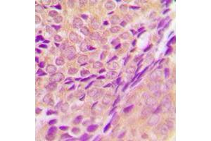 Immunohistochemical analysis of ZADH2 staining in human breast cancer formalin fixed paraffin embedded tissue section. (ZADH2 antibody  (Center))