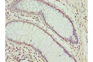 Immunohistochemistry of paraffin-embedded human colon cancer using ABIN7148653 at dilution of 1:100 (CPXCR1 antibody  (AA 1-301))