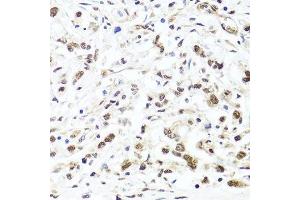 Immunohistochemistry of paraffin-embedded human gastric cancer using HIRA antibody. (HIRA antibody  (AA 250-550))