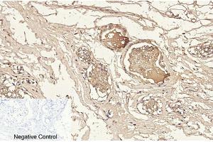 Immunohistochemical analysis of paraffin-embedded human breast tissue. (Caspase 3 p12 (AA 130-210), (Cleaved-Asp175) antibody)
