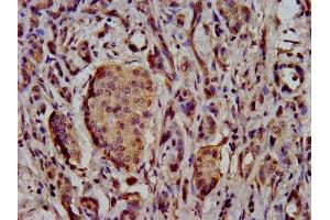 IHC image of ABIN7169920 diluted at 1:500 and staining in paraffin-embedded human pancreatic cancer performed on a Leica BondTM system. (SCN11A antibody  (AA 403-551))