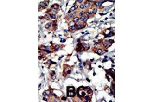 Formalin-fixed and paraffin-embedded human cancer tissue reacted with PACSIN3 polyclonal antibody  , which was peroxidase-conjugated to the secondary antibody, followed by AEC staining. (PACSIN3 antibody  (N-Term))