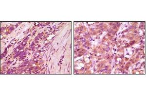 Immunohistochemical analysis of paraffin-embedded human stomach carcinoma (left) and breast carcinoma (right), showing cytoplasmic localization using fibulin5 antibody with DAB staining. (Fibulin 5 antibody)
