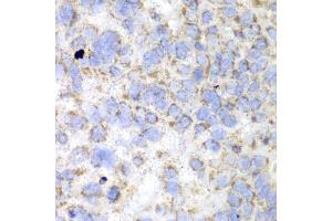 Immunohistochemistry of paraffin-embedded human esophageal cancer using HADHA antibody (ABIN6292979) at dilution of 1:100 (40x lens). (HADHA antibody)