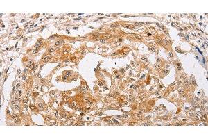Immunohistochemistry of paraffin-embedded Human cervical cancer using PPP1CB Polyclonal Antibody at dilution of 1:30 (PPP1CB antibody)