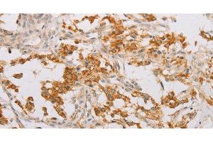 Immunohistochemistry of paraffin-embedded Human thyroid cancer tissue using STK40 Polyclonal Antibody at dilution 1:40 (STK40 antibody)