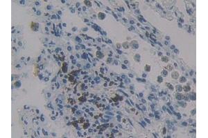Detection of MCP4 in Human Lung cancer Tissue using Polyclonal Antibody to Monocyte Chemotactic Protein 4 (MCP4) (CCL13 antibody  (AA 24-98))