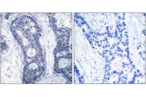 Immunohistochemistry analysis of paraffin-embedded human breast carcinoma tissue, using eIF4E (Ab-209) Antibody.
