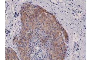 Immunohistochemical staining (Formalin-fixed paraffin-embedded sections) of human breast cancer with ACACA/ACACB (phospho S79) monoclonal antibody, clone RM270 . (Acetyl-CoA Carboxylase alpha antibody  (pSer79))