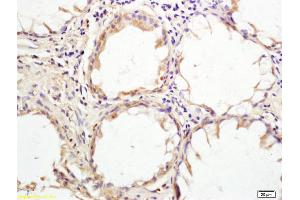 Formalin-fixed and paraffin embedded human rectal carcinoma tissue labeled with Anti HHLA2 Polyclonal Antibody, Unconjugated (ABIN1388019) at 1:200 followed by conjugation to the secondary antibody and DAB staining (HHLA2 antibody  (AA 231-330))