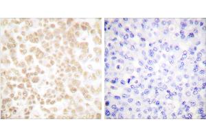 Peptide - +Immunohistochemical analysis of paraffin-embedded human breast carcinoma tissue using Fra-2 antibody (#C0197). (FOSL2 antibody)