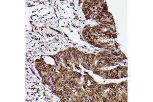 Immunohistochemistry of paraffin-embedded human colon carcinoma using ERK1 Rabbit mAb  at dilution of 1:100 (40x lens). (ERK1 antibody)