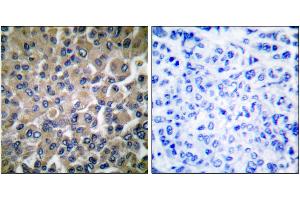 Immunohistochemical analysis of paraffin-embedded human breast carcinoma tissue using GRP78 antibody.