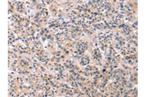 The image on the left is immunohistochemistry of paraffin-embedded Human liver cancer tissue using ABIN7192749(TCERG1L Antibody) at dilution 1/30, on the right is treated with synthetic peptide. (TCERG1L antibody)