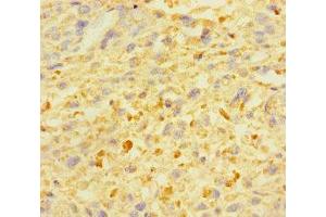 Immunohistochemistry of paraffin-embedded human melanoma using ABIN7176008 at dilution of 1:100 (ZSCAN29 antibody  (AA 1-300))