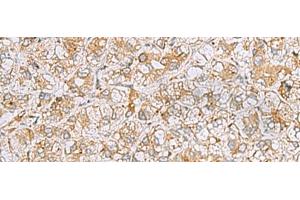 Immunohistochemistry of paraffin-embedded Human liver cancer tissue using FERMT1 Polyclonal Antibody at dilution of 1:30(x200) (FERMT1 antibody)