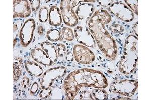 Immunohistochemical staining of paraffin-embedded Carcinoma of liver tissue using anti-BTK mouse monoclonal antibody. (BTK antibody)