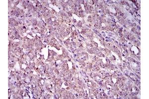 Immunohistochemical analysis of paraffin-embedded cervical cancer tissues using ITGA2B mouse mAb with DAB staining. (Integrin Alpha2b antibody  (AA 45-149))