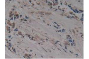 IHC-P analysis of Human Breast Cancer Tissue, with DAB staining. (MAPT antibody  (AA 130-386))