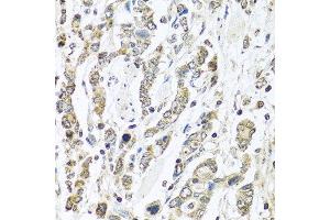 Immunohistochemistry of paraffin-embedded human gastric cancer using IFNL3 antibody at dilution of 1:100 (40x lens). (IL28B antibody)