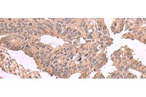Immunohistochemistry of paraffin-embedded Human colorectal cancer tissue using MAGEC2 Polyclonal Antibody at dilution of 1:60(x200) (MAGEC2 antibody)